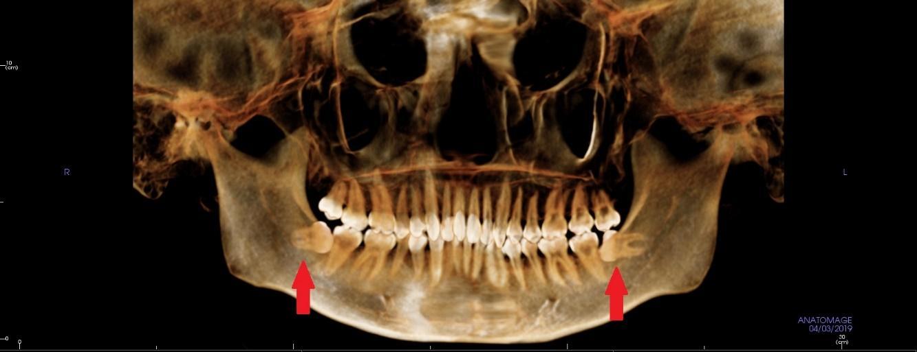大人の親知らずのCT画像,21才,広島市,西区,草津新町,アルパーク歯科・矯正・栄養クリニック