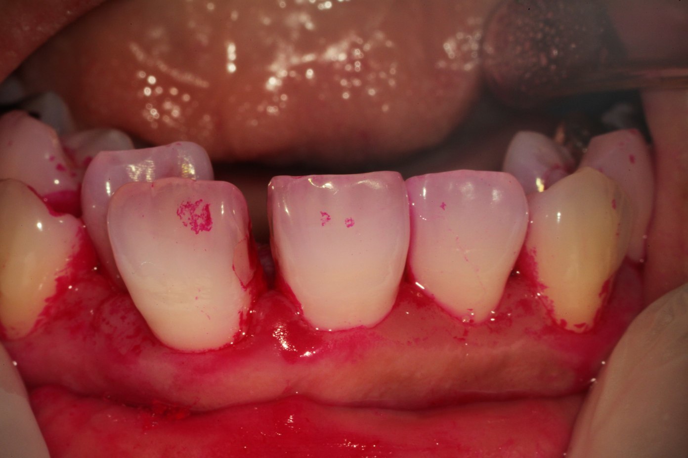 歯茎が、腫れて出血する 歯周病は、顕微鏡でどう治療するのか? 広島市西区のアルパーク歯科・矯正歯科
