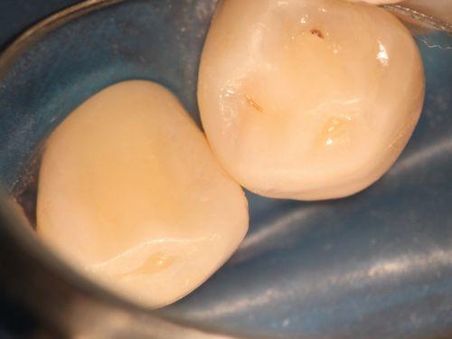 歯がしみる原因　気がつかない虫歯の写真,広島市,西区,草津新町,アルパーク歯科・矯正・栄養クリニック