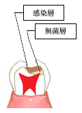 軟化象牙質について