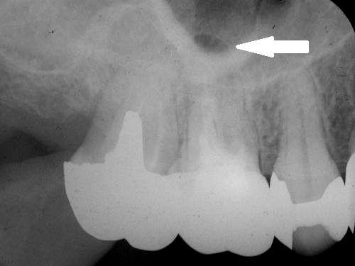 「根管治療のやり直しより、抜いてインプラントにした方が良い」と言われた歯のレントゲン写真,広島市,西区,草津新町,アルパーク歯科・矯正・栄養クリニック