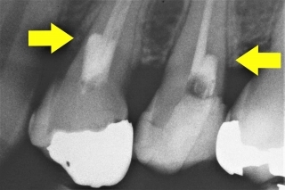 根管治療でダイヤモンドバーが突き抜けそう,レントゲン写真,広島市西区草津新町,アルパーク歯科・矯正・栄養クリニック