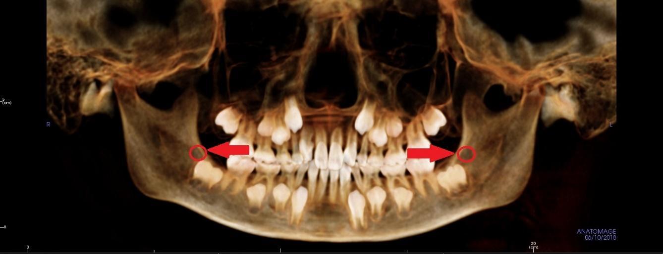 子供の小さい親知らず（歯胚）のCT画像,8才,広島市,西区,草津新町,アルパーク歯科・矯正・栄養クリニック