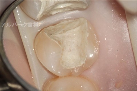 仮歯の除去