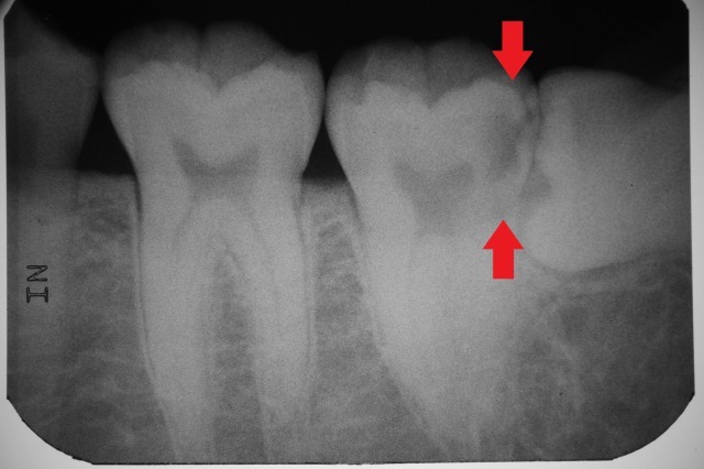 虫歯を取りきるためには、どうしたらいいのか? カリエスチェック(う蝕検知液)の画像,広島市,西区,草津新町,アルパーク歯科・矯正・栄養クリニック