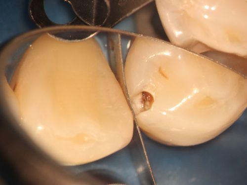 歯がしみる原因 気がつかない虫歯の画像,広島市,西区,草津新町,アルパーク歯科・矯正・栄養クリニック
