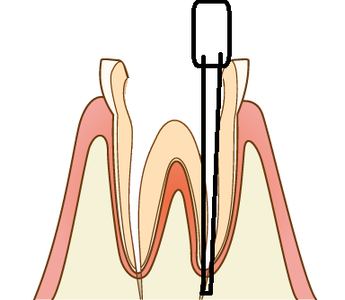 根管長のまちがい