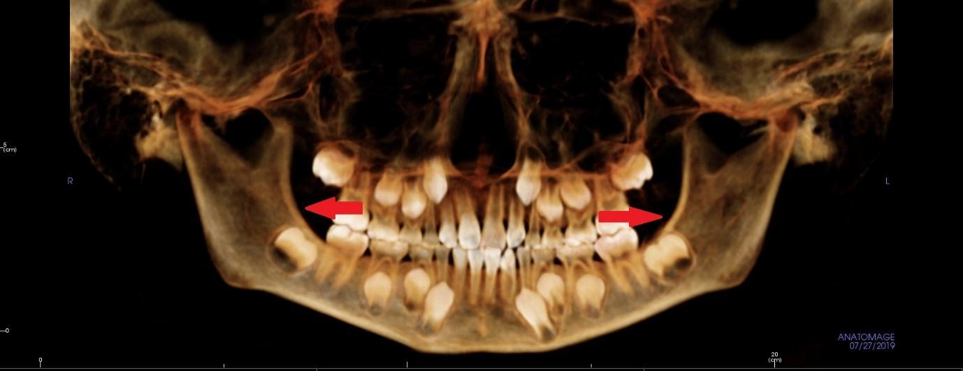 親知らず（歯胚）がないCT画像,8才,広島市,西区,草津新町,アルパーク歯科・矯正・栄養クリニック