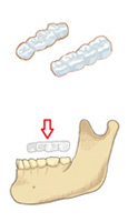 下に装着　奥歯が噛むもの
