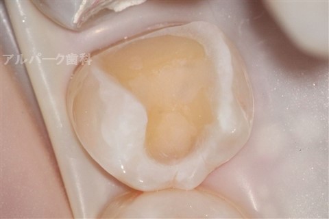 歯の接着面処理