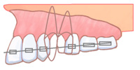 歯根をできるだけ直立させます