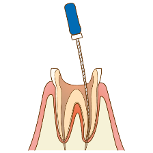 根管を掃除