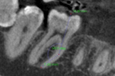根管治療 リーマーの突き抜け,CTで根管長測定の画像,広島市西区草津新町,アルパーク歯科・矯正・栄養クリニック